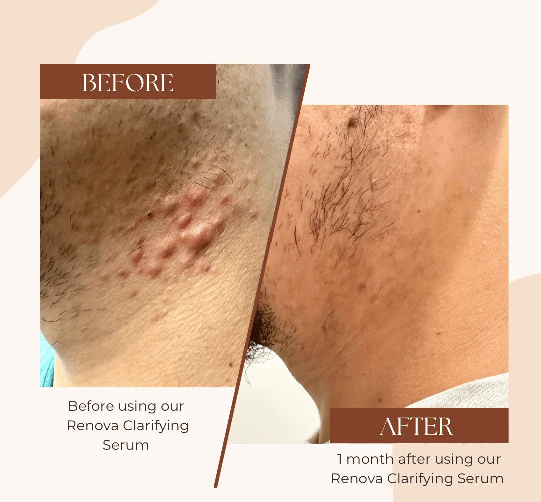 Evatasha Facial Care Renova Clarifying Serum (For Acne Prone Skin)