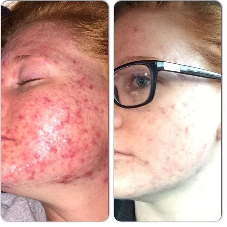 Timeless Organics Skin Care Kit 3-Step Acne System