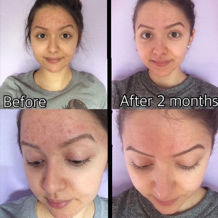 Timeless Organics Skin Care Kit 3-Step Acne System