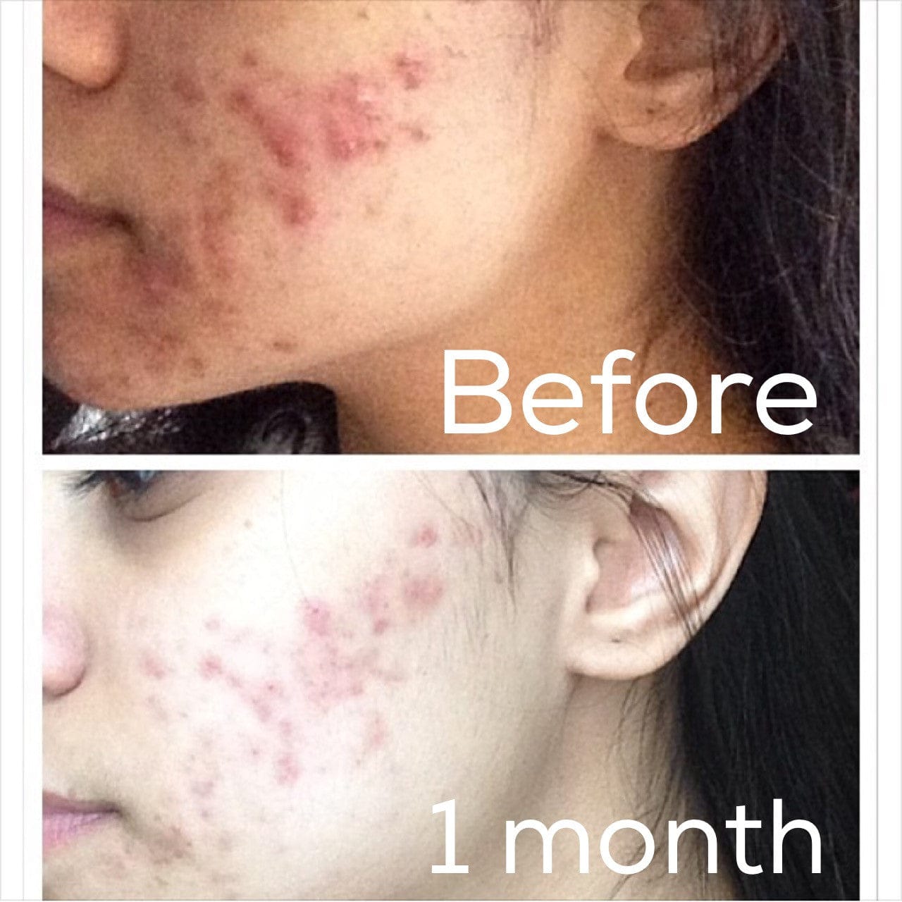 Timeless Organics Skin Care Kit 3-Step Acne System