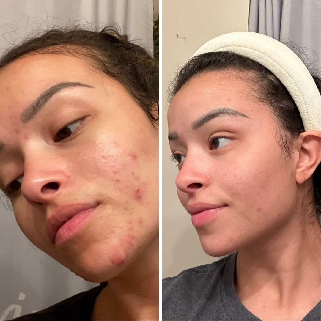 Evatasha Facial Care Renova Clarifying Serum (For Acne Prone Skin)