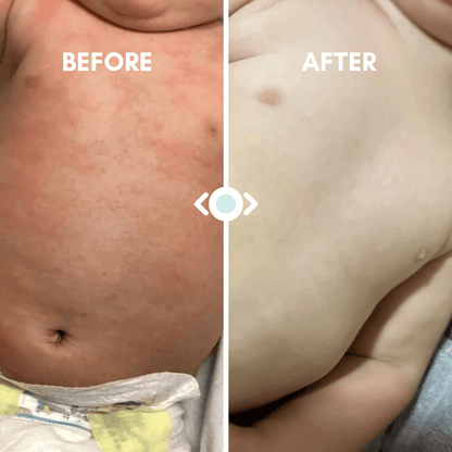 Baby Eczema Relief Bundle
