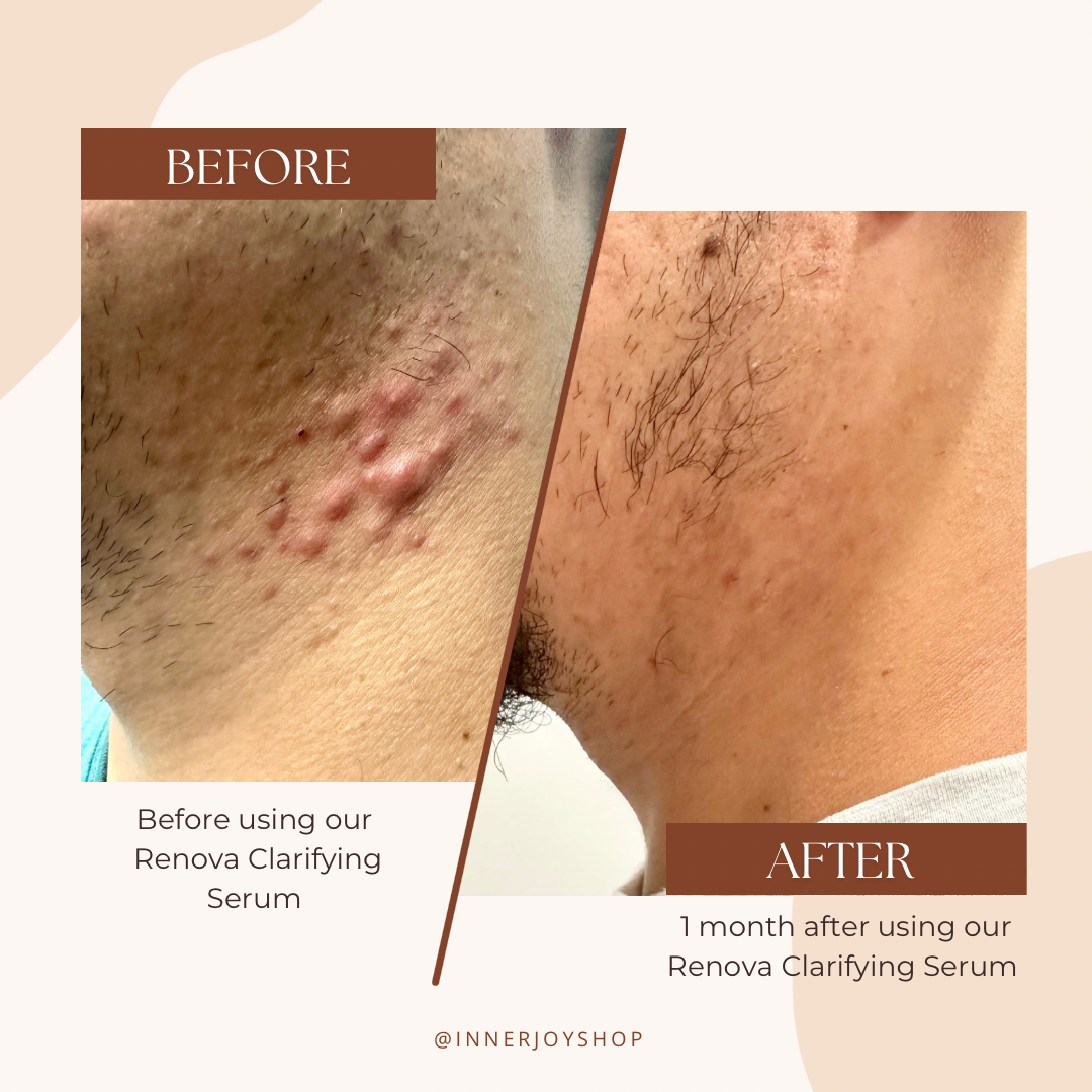 Renova Clarifying Serum (For Acne Prone Skin)