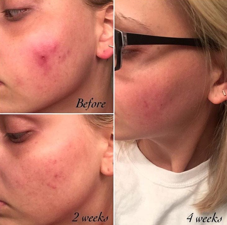 Timeless Organics Skin Care Kit 3-Step Acne System