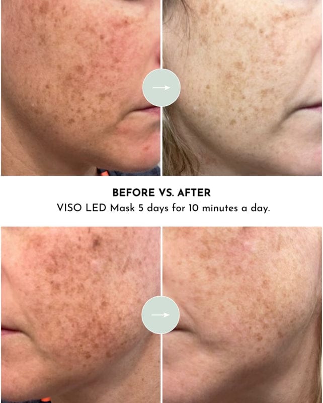 Lumara Health &amp; Beauty VISO - FDA Certified Red Light Therapy Mask