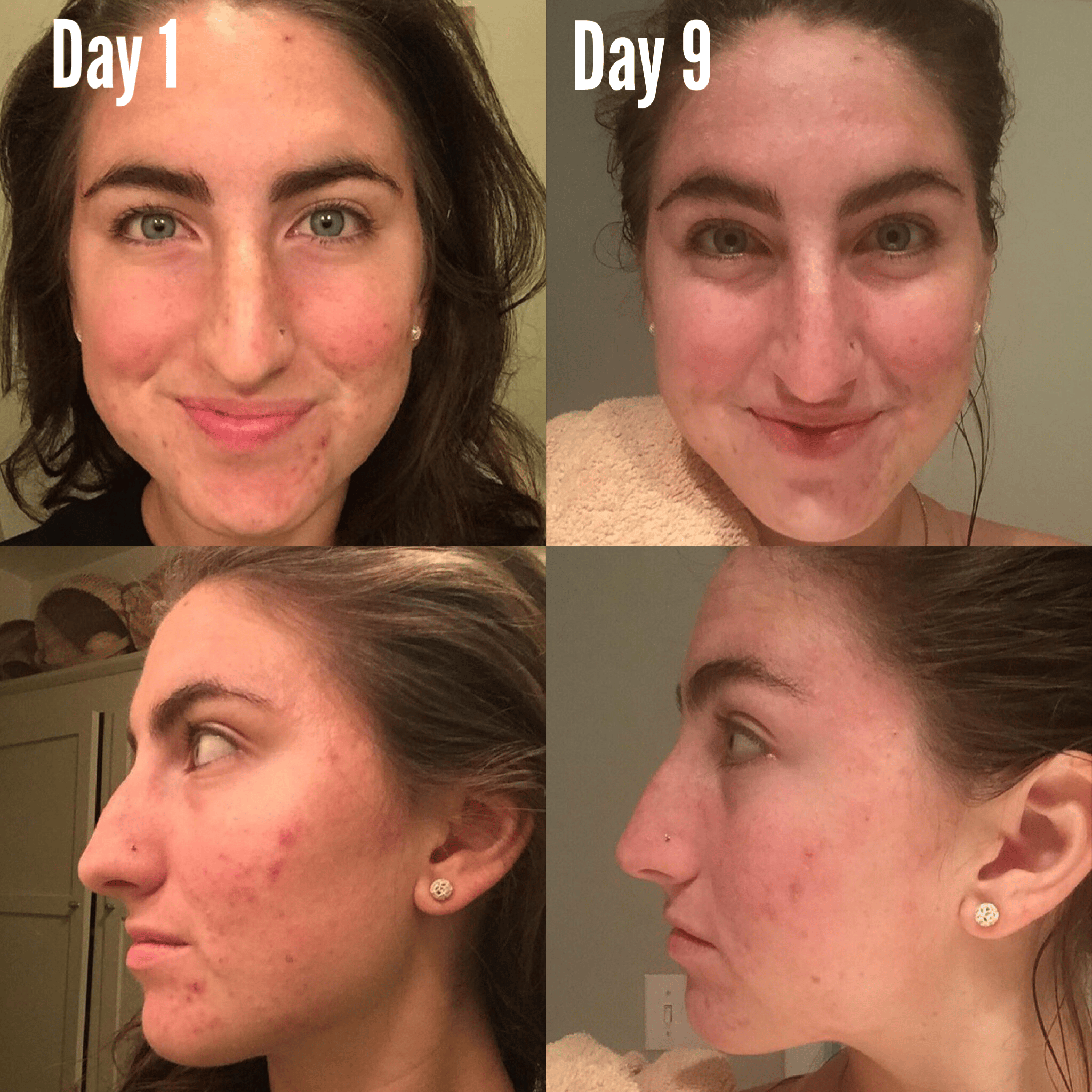 Timeless Organics Skin Care Kit 3-Step Acne System