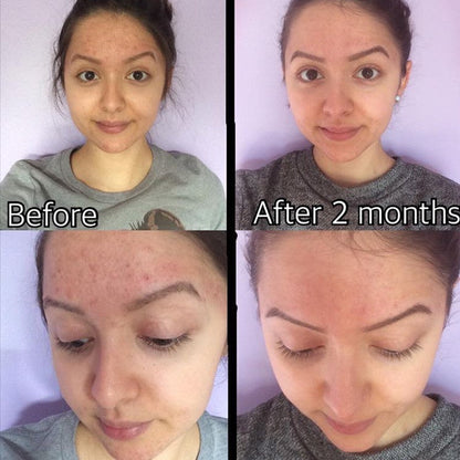 3-Step Acne System - My American Goods