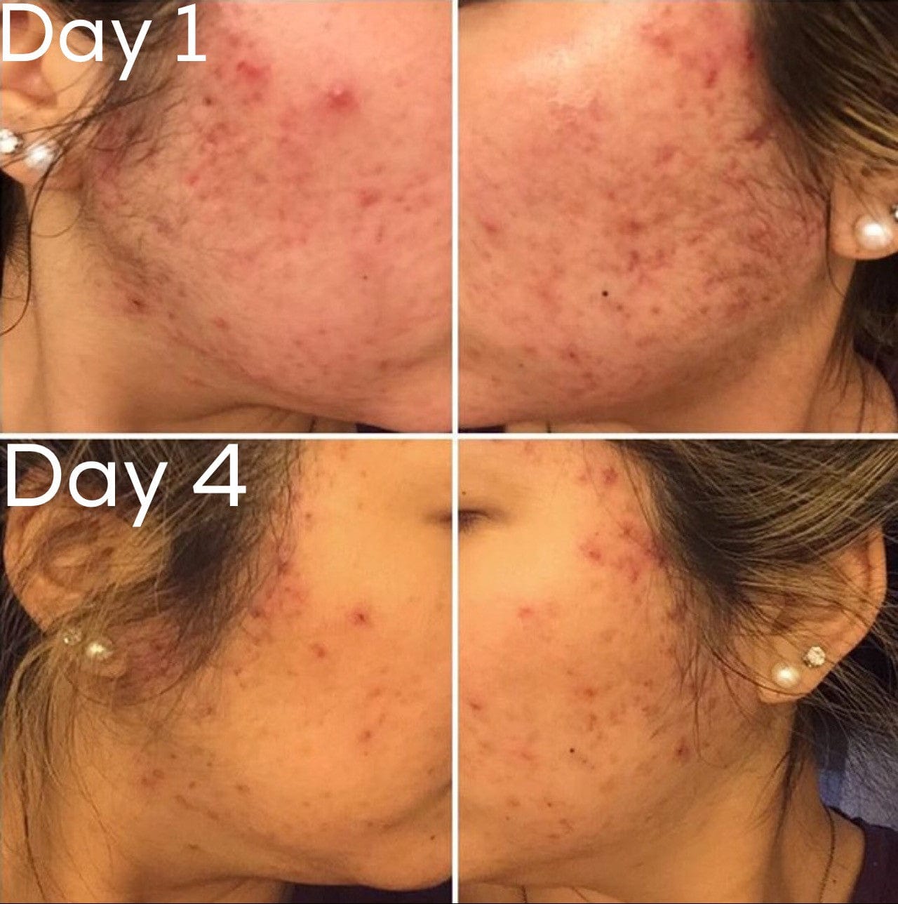 Timeless Organics Skin Care Kit 3-Step Acne System